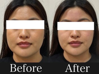 リズボディ(RizBody)/【Before After】施術1回目