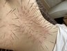 【慢性的な腰痛に！】ルート鍼施術 60分　¥20,000→¥15,000