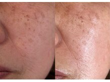 ルアーナ(Luana)/悩み　ほうれい線、目周りのしわ