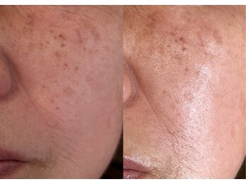 ルアーナ(Luana)/悩み ほうれい線、目周りのしわ