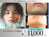 【カウンセリングなし】爆抜け特化型 陰部などMパーツ脱毛 1部位