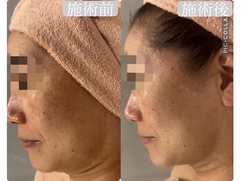 ハイフン(HIFUN)/【小顔×チタニウムリフト】