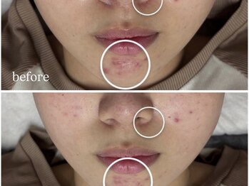 アンリミット 鹿児島天文館店(Une limit)/赤みのあるニキビケア