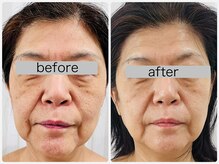 肌質改善☆ハリ・ツヤ・毛穴がハイドラプラズマエステで叶う