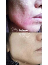 セレネ(SELENE)/赤み、凸凹肌、たるみ