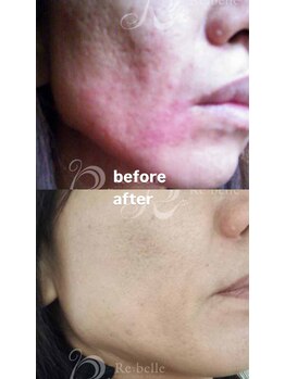 セレネ(SELENE)/赤み、凸凹肌、たるみ