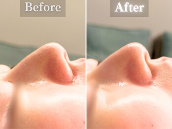 ボーンオム(Born Homme)/毛穴洗浄＋美容液導入：20代女性