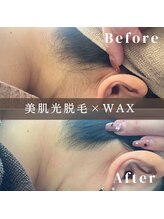 エピナ 横浜店(Epina)/うなじ脱毛/ブライダル脱毛