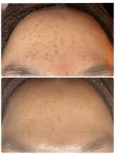 ティエラ(TIERRA)/シミケア