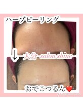 サロンシャイン(Salon Shine)/ハードハーブピーリング１回