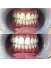 ラブホワイトニング 銀座店(LOVEホワイトニング)/＃ホワイトニング 