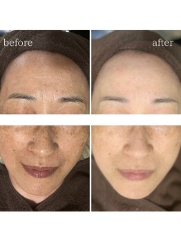 マーギアー(Magier)/ハーブ＋ダーマ　初来店→6回