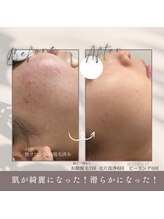 モアトゥインクル 福山宮通り店(MORE twinkle)/肌荒改善◎