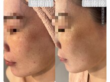 ハイフン(HIFUN)/【小顔×チタニウムリフト】毛穴