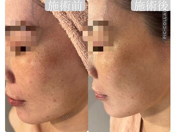 ハイフン(HIFUN)/【小顔×チタニウムリフト】毛穴