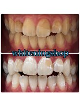 ホワイトニングショップ 豊橋店(WHITENING SHOP)/ホワイトニングで着色リセット！