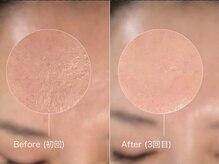 ウルト アルティメイトスキン(ULT ultimate skin)/《韓国美容》雪花スノーピール！