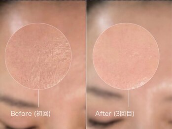 ウルト アルティメイトスキン(ULT ultimate skin)/《韓国美容》雪花スノーピール!