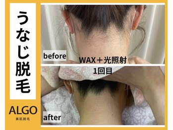 アルゴ 山口店(ALGO)/アルゴ式WAX脱毛+光脱毛