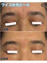 グレース(GRACE)/ワイコ水光ピール