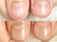 深爪矯正 爪悩み専門店 グラシナ 西宮北口店【4/3 NEW OPEN（予定）】/