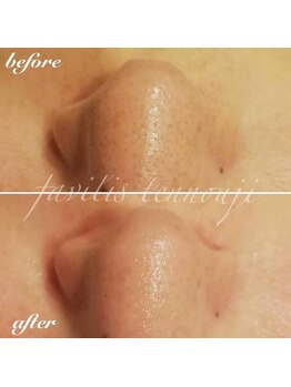 ファビリス 天王寺店(FAVILIS)/ハイドロスプラッシュ1回/30代