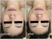 エスティ 京都店/整顔　before/after