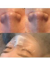 ユキ(YUKI)/毛穴の黒ずみケア