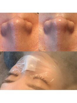 ユキ(YUKI)/毛穴の黒ずみケア