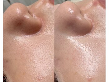 アマト 心斎橋店(Amato)/心斎橋/顔脱毛/フェイスワックス