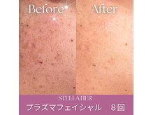 ステラティエ(Stellatier)