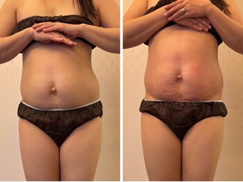 ライトウェーブ 松本村井本店/フォースカッター1回の効果