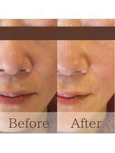 凪眠/小顔リンパフェイシャルの効果2