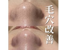 ミラーヴ(MERAVE)/徹底的に詰まりを取る！