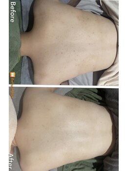 ミーアップ(Me up)/背中ニキビケア