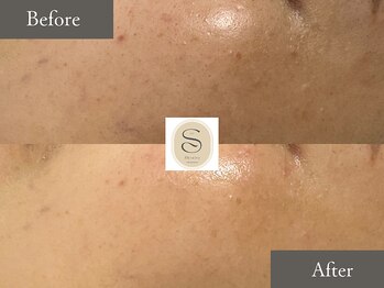 スキニティ(Skinity)/ハイドラフェイシャル/毛穴洗浄