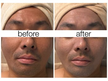 ハリスキンラボ(Hari.Skin.Lab)/40代のお客様/1回での施術効果