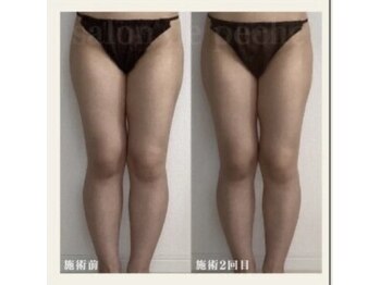 サロンドペシェ(salon de peche)/20代*痩身コース2回目