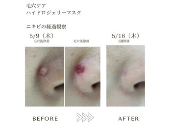 サロンエイトミー 西船橋店(salon 83)/ニキビケア/毛穴before→after