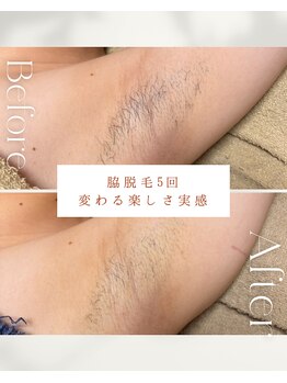 ビーエックス(.BX)/全身脱毛・ワキ脱毛・脇脱毛