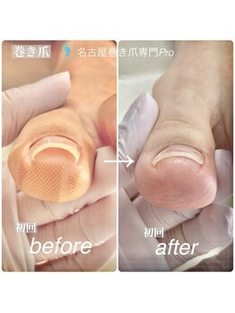 名古屋巻き爪専門Proの写真/【巻き爪・陥入爪にお悩みの方へ】巻き爪・繰り返す爪の痛みから解放！施術で足が軽くなる喜びをあなたに☆