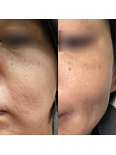 エムズビューティー(M’s Beauty)/ハーブピーリング1回目のお客様