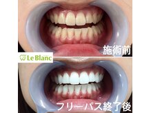 ルブラン 奈良店(Le Blanc)/1日30分のケアで白い歯に！