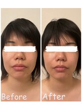 ピピ 三軒茶屋(pipi)/小顔矯正フェイシャルコース1回