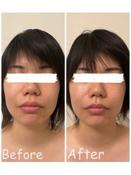 ピピ 三軒茶屋(pipi)/小顔矯正フェイシャルコース1回