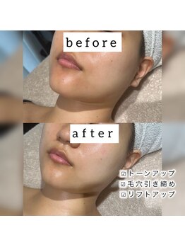 フリーク バイ シュリット 渋谷(fleek! by schritt)/【強炭酸カーボキシーパック】