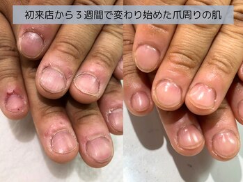 アリエ(allie)/カサカサだった皮膚が原因で深爪