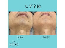 アクト クロ(ACT curro)/【ヒゲ全体】脱毛施術例