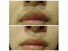 メンズ エステティック ヒーロー(men's esthetic HERO)の雰囲気（青みが無くなり印象UP♪）