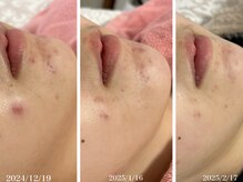 メルシア(merucia)/跡、ニキビケア、赤み改善